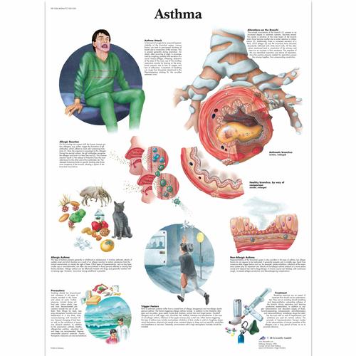Chart Of Asthma