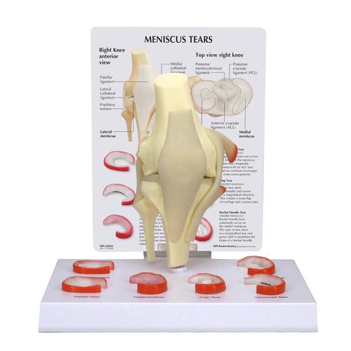 Meniscus Knee Model with 6 Tears, 1019500, Joint Models