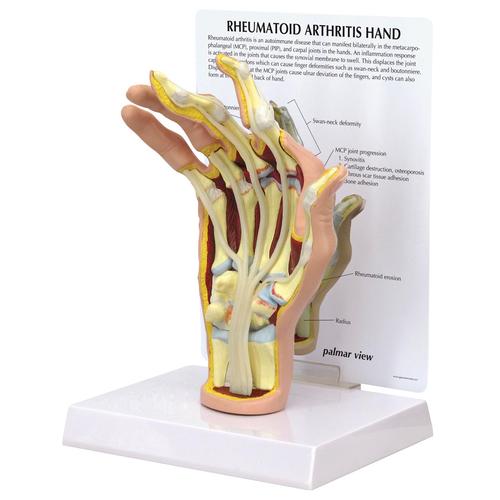 Rheumatoid Arthritis Hand Model, 1019521, Arm and Hand Skeleton Models
