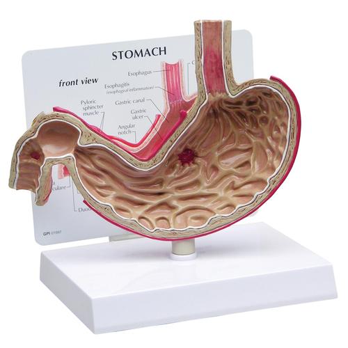 Stomach Model with Ulcers, 1019523, Digestive System Models