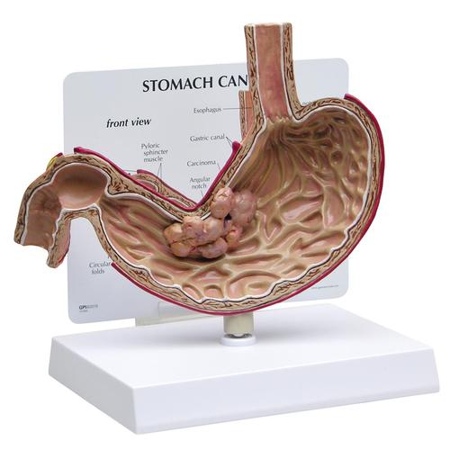 Stomach Cancer Model, 1019524, Digestive System Models