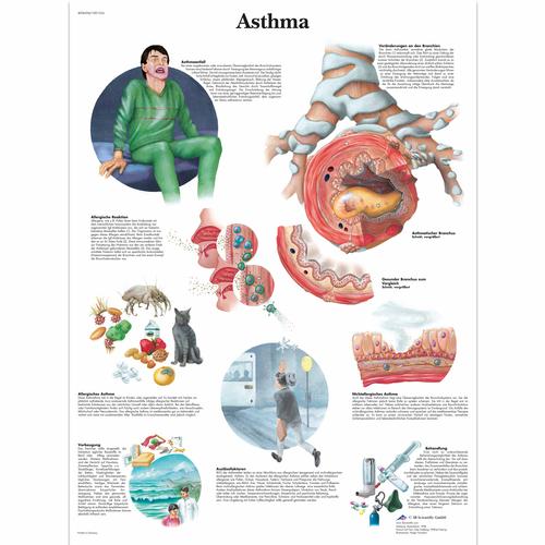 Asthma Chart, 4006594 [VR0328UU], Asthma and Allergies Education