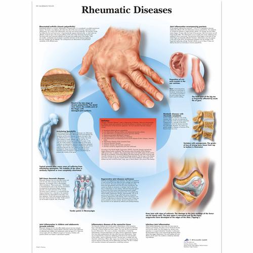 Rheumatic Diseases Chart, 4006655 [VR1124UU], Skeletal System