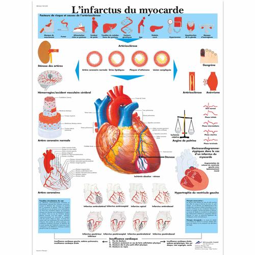 L'infarctus du myocarde, 1001692 [VR2342L], Heart Health and Fitness Education