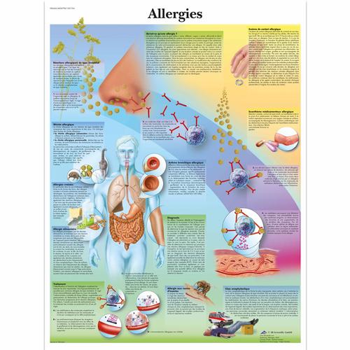 Allergies Chart, 1001765 [VR2660L], Immune System 