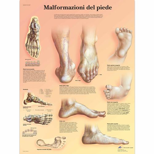 Malformazioni di piede, 4006909 [VR4185UU], Skeletal System
