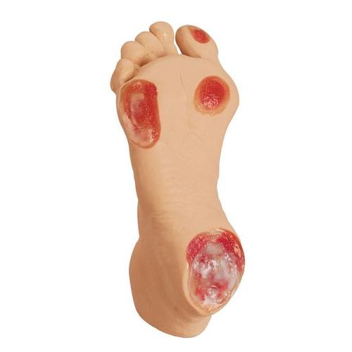 Elderly Pressure Ulcer Foot, 1013058 [W44757], Decubitus Care