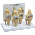 4-Stage Osteo Knee Model Set, 1019502, Joint Models