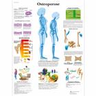 Osteoporose Chart, 4006570 [VR0121UU], Arthritis and Osteoporosis Education