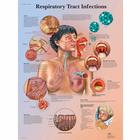 Respiratory Tract Infections Chart, 1001508 [VR1253L], Respiratory System