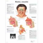 Rinitis y sinusitis, 4006831 [VR3251UU], Ear, Nose and Throat (ENT)