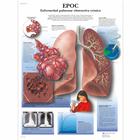 EPOC Enfermedad pulmonar obstructiva crónica, 4006840 [VR3329UU], Tobacco Education
