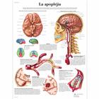 La apoplejía, 1001919 [VR3627L], Cardiovascular System